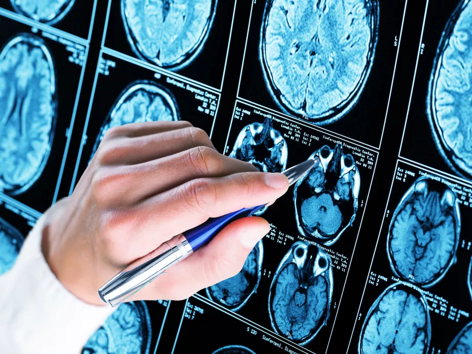 Az AI találkozása az Alzheimer-kórral